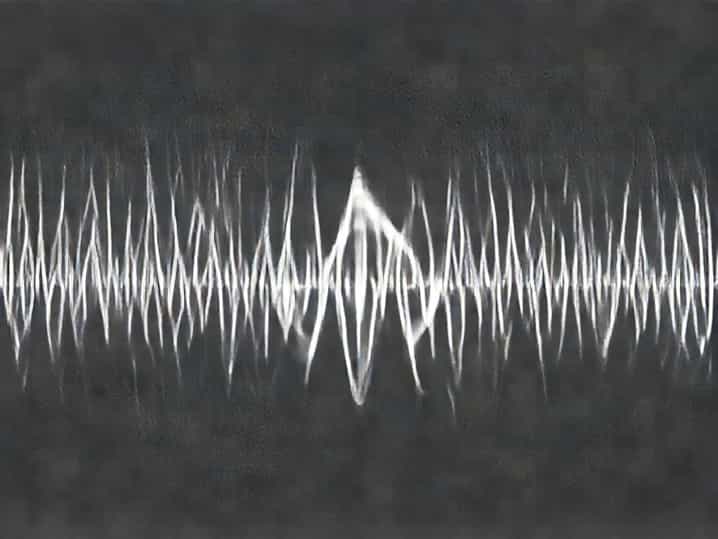 Zone 3 Sinusoidal Dilatation