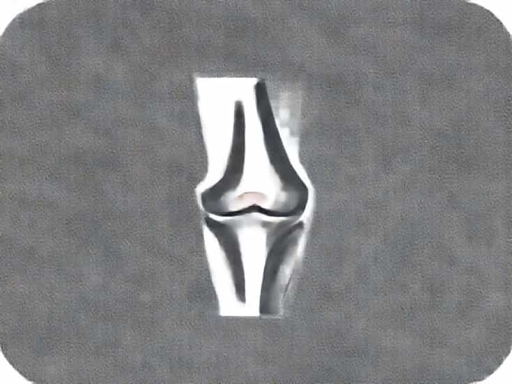 Cartilage Tear In Knee