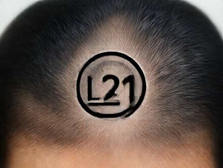 L21 0 Seborrhea Capitis
