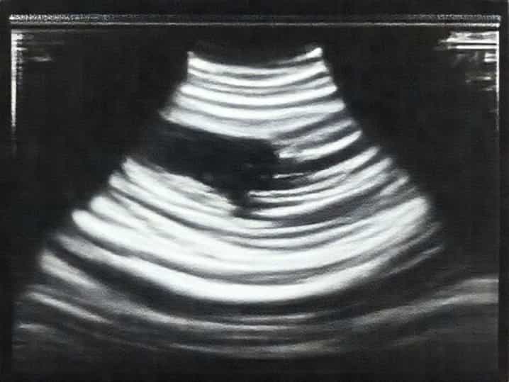 Ultrasound At 10 Weeks