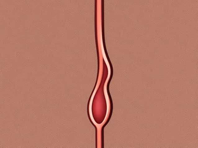 Ureteric Bud Develops From