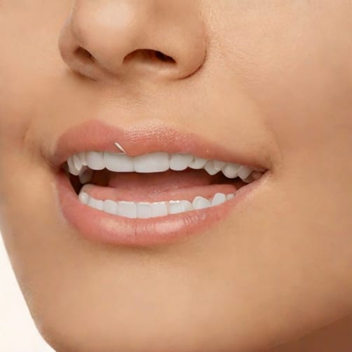 Zig Zag Permanent Retainer