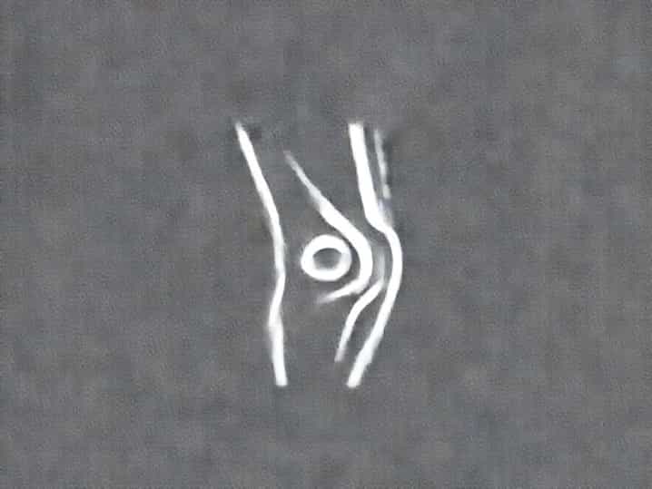 Back Of Knee Twinge
