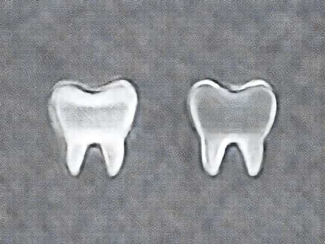 Difference Between Maxillary And Mandibular Premolars