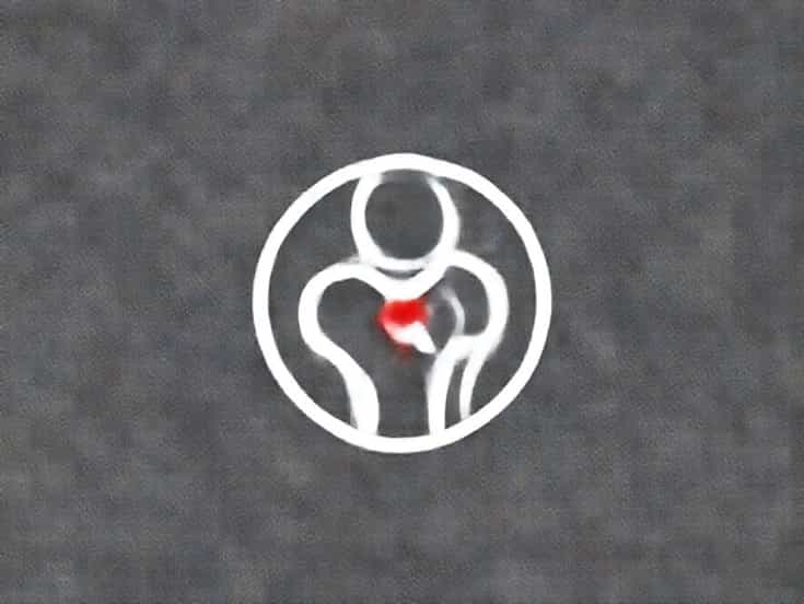 A Rotator Cuff Tear