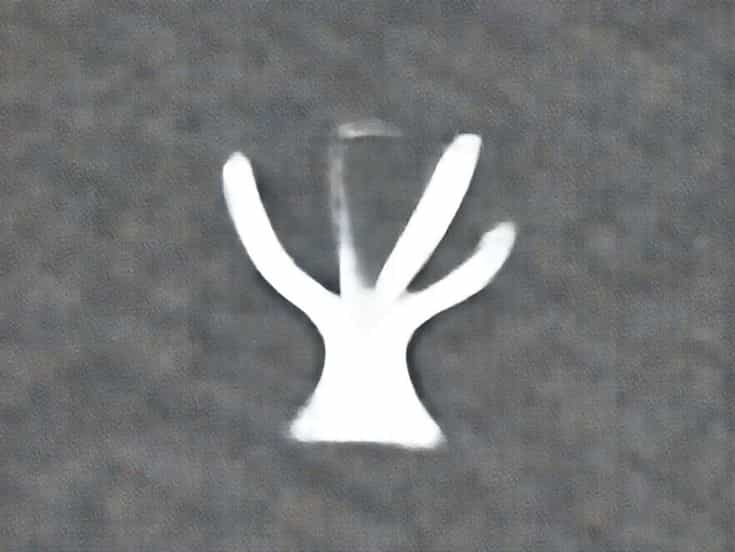 Mild Aortic Root Dilation