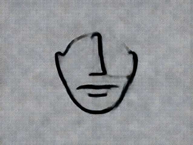 Vomer Flap Cleft Palate