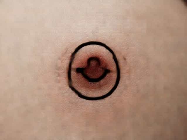 How Do You Get A Birthmark