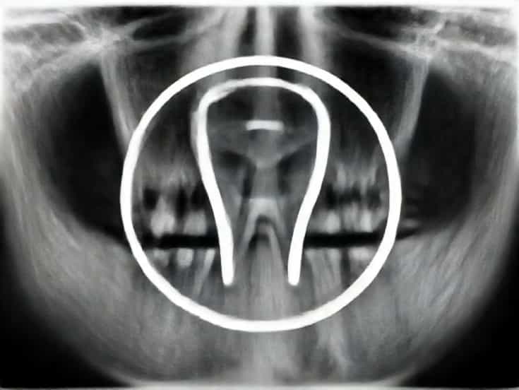 Incipient Caries X Ray