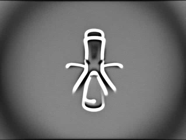 Tubal Blockage X Ray