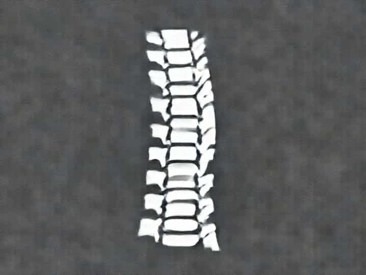 X Ray Vertebral Column
