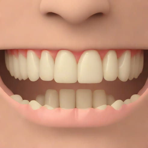 Keel Shaped Maxillary Alveolus